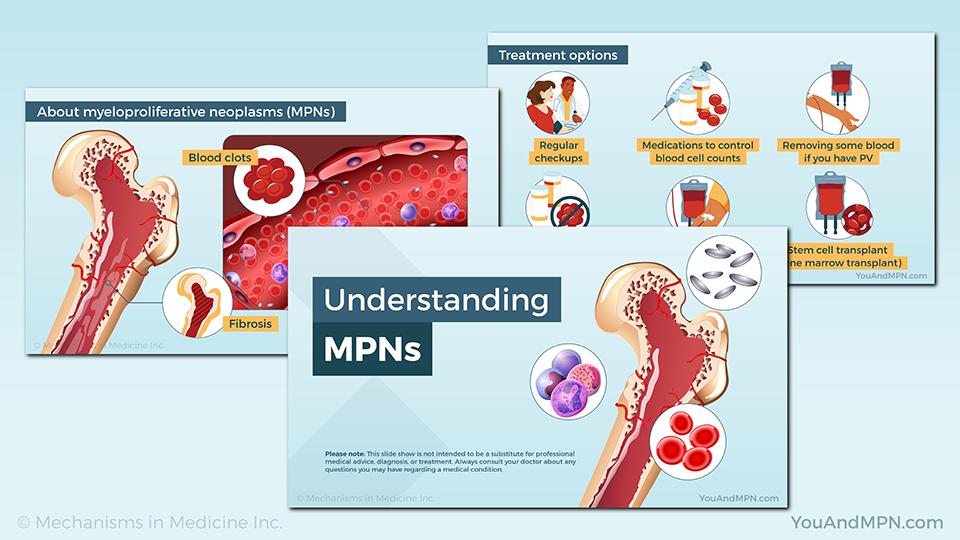 Understanding MPNs — Slide Show