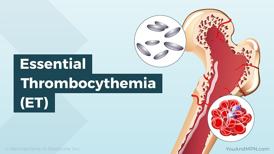 Essential Thrombocythemia (ET)