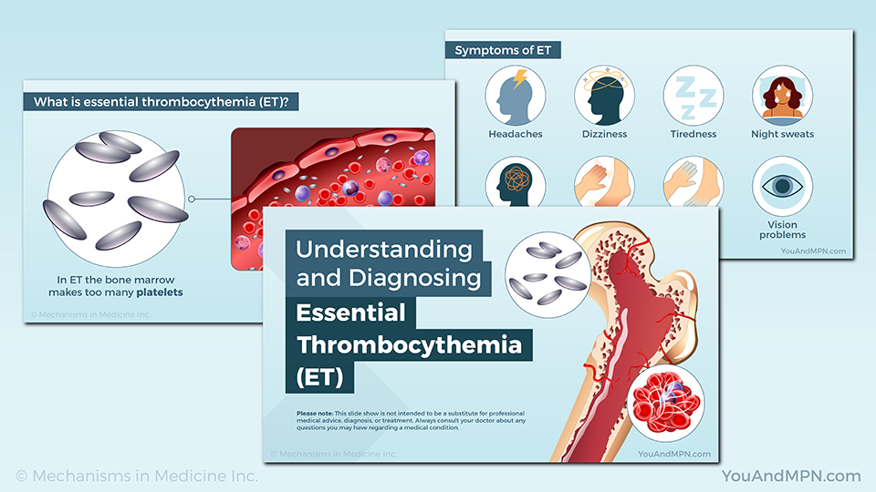 Understanding and Diagnosing Essential Thrombocythemia (ET) — Slide Show