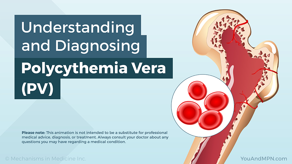 Understanding and Diagnosing Polycythemia Vera (PV) — Animation