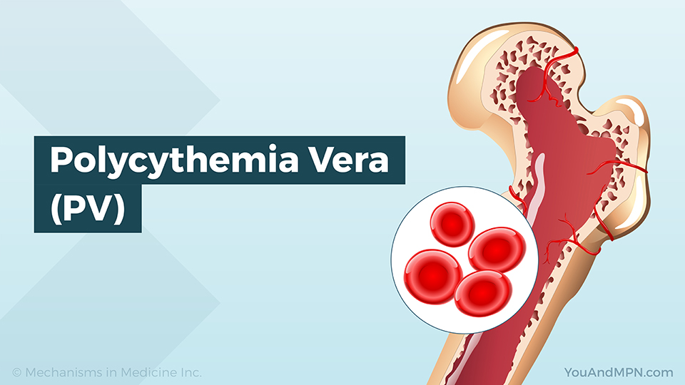 Polycythemia Vera (PV)