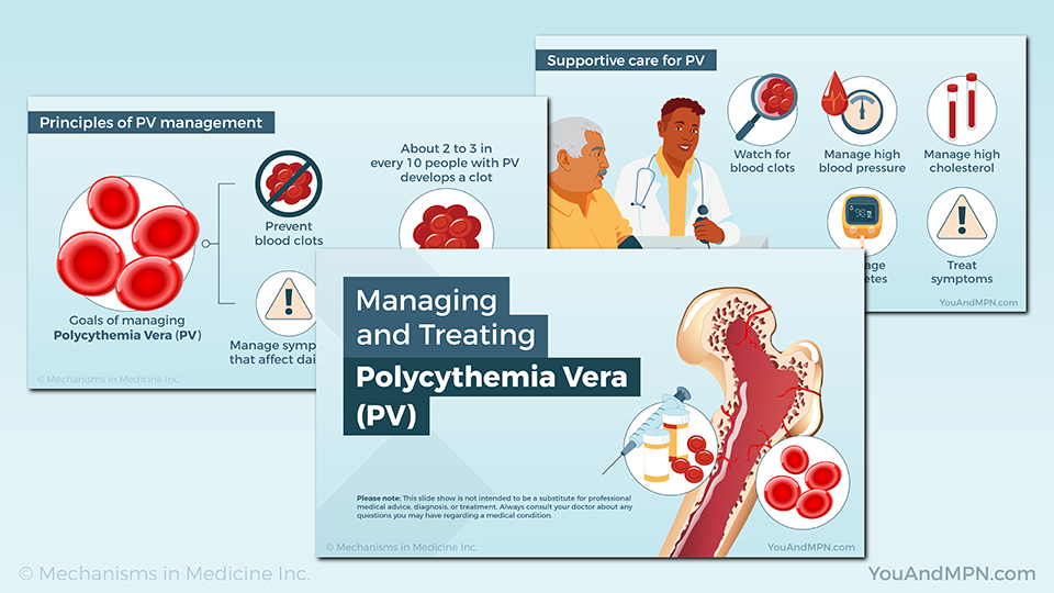 Managing and Treating Polycythemia Vera (PV) — Slide Show