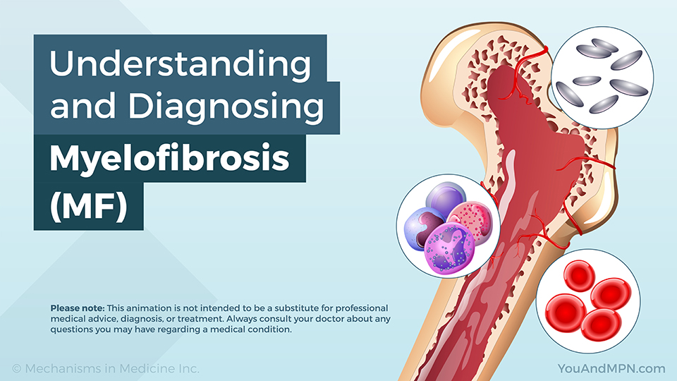 Understanding and Diagnosing Myelofibrosis (MF) — Animation