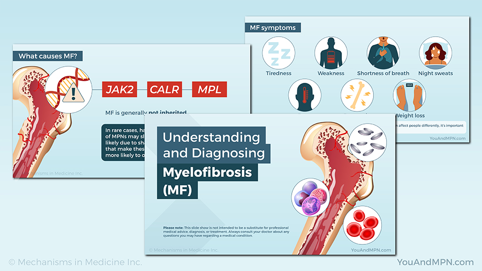 Understanding and Diagnosing Myelofibrosis (MF) — Slide Show