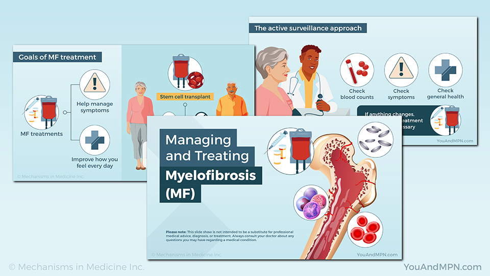 Managing and Treating Myelofibrosis (MF) — Slide Show